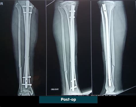 Orthopedic Trauma (Fracture) Treatment | Ahmedabad | Dr. Rachit Sheth