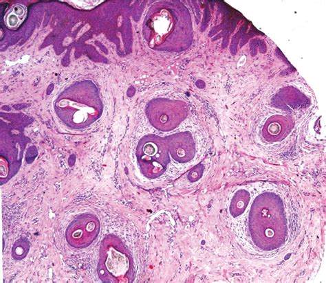 Scarring Alopecia Histology