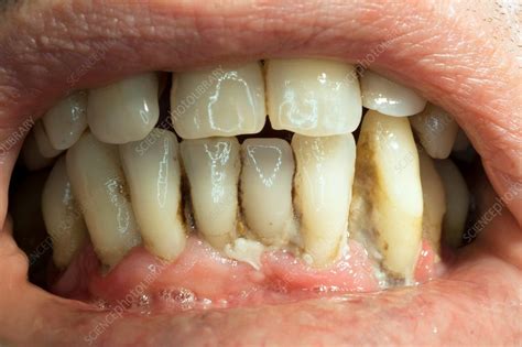 Teeth covered with plaque and tartar - Stock Image C034/2621 - Science ...