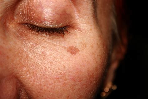 Reversing Sun Damaged Skin | Dermatology in Keller, TX