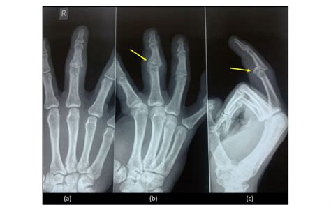 Radiographs 3 months after injury showed comminuted unstable malunion ...