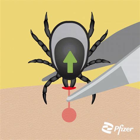 TickAlert | Tick-borne encephalitis | How to remove a tick