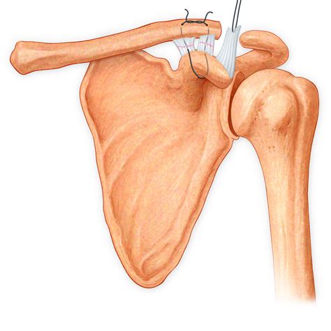 Shoulder Ligament Repair Stock Art