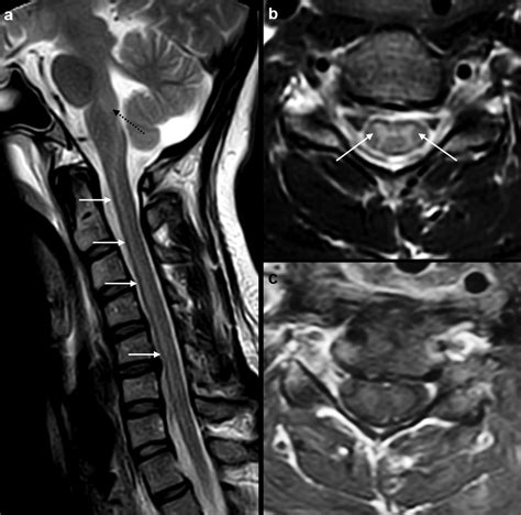 -MRI cervical spine study at time of admission in ICU of our institute ...