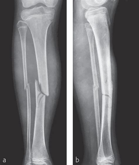 Tibia and fibula, shaft: simple fracture, oblique | Musculoskeletal Key