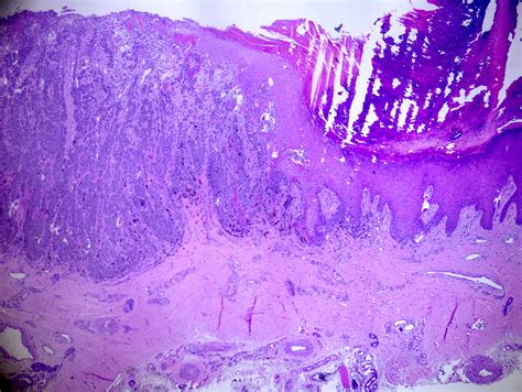 Acral Lentiginous Melanoma Histology