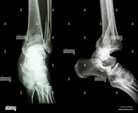 film x-ray ankle AP/Lateral : show fracture distal tibia and fibula ...