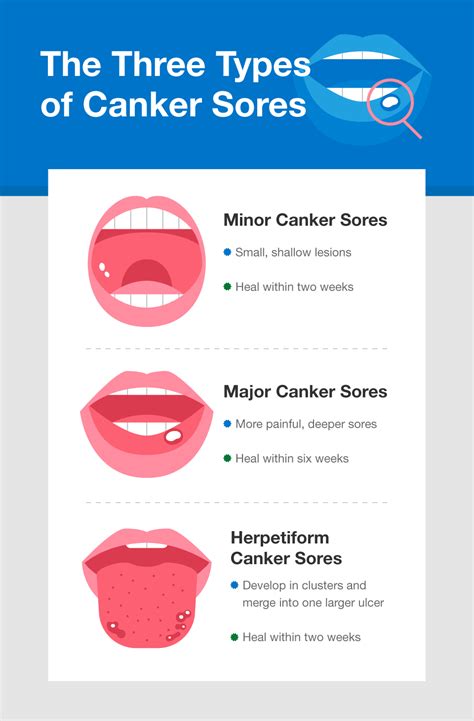 What Causes Canker Sores and How to Get Rid of Them - SmartMouth