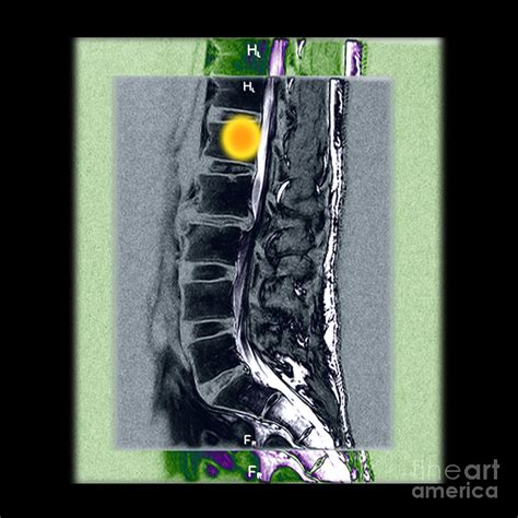 Mri Of Vertebral Hemangioma Photograph by Living Art Enterprises - Fine ...