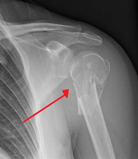 What Are Proximal Humerus Fractures? – Orthopedic Implants for Tendons ...