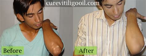 Vitiligo Treatment - Vitiligo Treatment Photo (30121406) - Fanpop