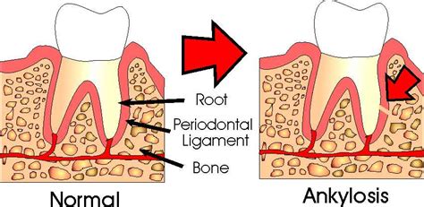 What are Ankylosed Teeth? | Ask an Orthodontist.com