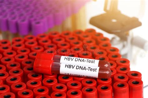 HBV DNA Test Test To Look for Abnormalities from Blood Stock Photo ...