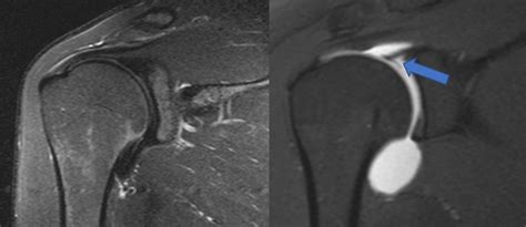 Superior Labral Anteroposterior Tear: Classification And, 59% OFF