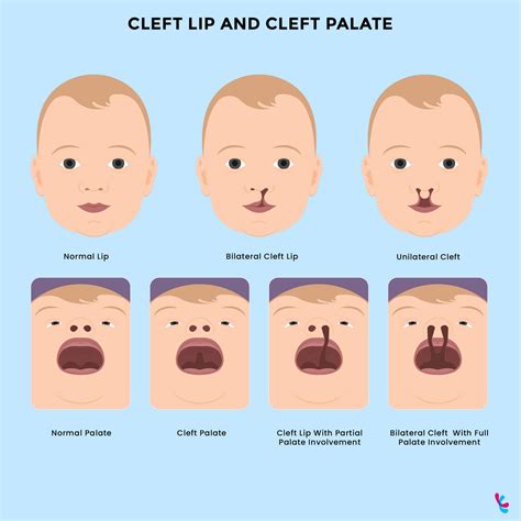 Is Cleft Lip Genetic? Facts about Cleft Lip and Palate