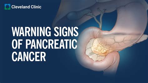 Symptoms and Signs of Pancreatic Cancer - Seena Magowitz Foundation