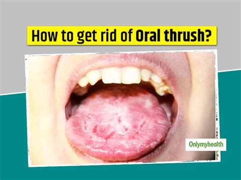 Want To Get Rid Of Oral Thrush? Here Are 10 Home Remedies To Help ...