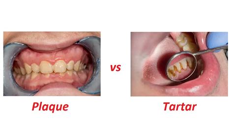 Plaque Vs. Tartar: 3 Key Differences – Difference Camp