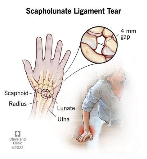 Wrist Sprains: Symptoms, Causes & Treatment (2023)