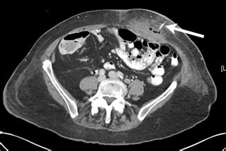 Jejunal Feeding Tube Complications | Abdominal Key