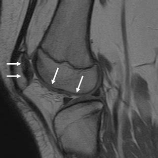 MRI scan showing a bone bruise on the lateral femoral condyle. Note the ...