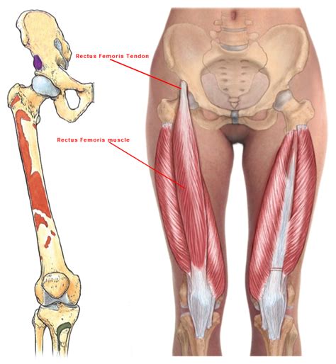 Surgical Repair of Rectus Femoris Tear - Orthopaedic Information ...