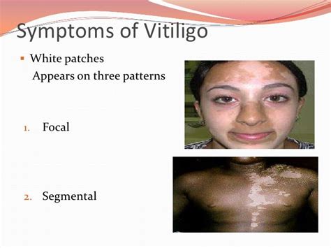 Vitiligo, causes and treatment