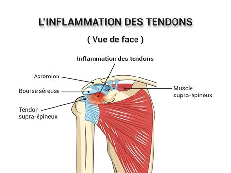 5 exercises to treat and relieve shoulder tendonitis