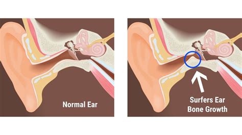 A Guide To Surfer’s Ear And How To Prevent It - Surf Indonesia