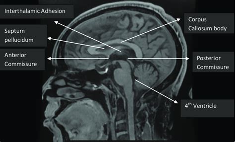 Mid-sagittal brain MRI showing the corpus callosum. | Download ...