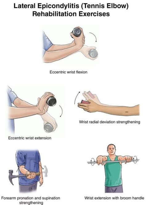 Lateral Epicondylitis Tennis Elbow Exercises