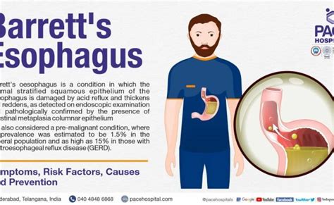 What Is Barrett S Esophagus Causes Symptoms Diagnosis Treatments ...