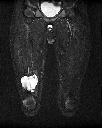 Hemangioma Mri