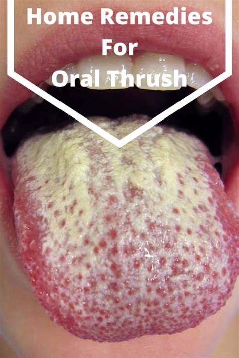 How To Get Rid Of Oral Thrush Fast Treatment