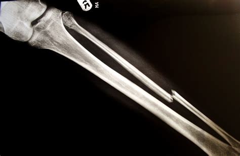 Malunion vs. nonunion fractures | OrthoIndy Blog