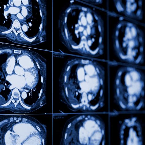 Radiation Levels: Radiation Levels Mri Vs Ct Scan