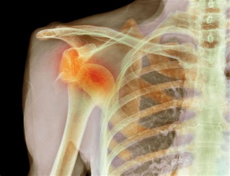 Shoulder Dislocation: Definition, Symptoms, and Causes