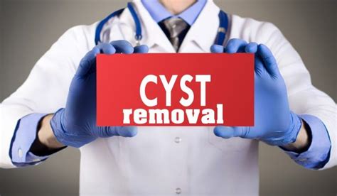 Cyst Removal | causes, diagnosis, treatment options, pictures