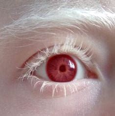 Oculocutaneous Albinism Eyes