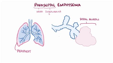 Emphysema Histology Comparison