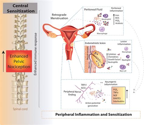 Endometriosis Pain