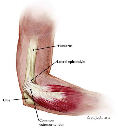 Lateral Epicondylitis (Tennis Elbow) - The Institute for Athletic Medicine