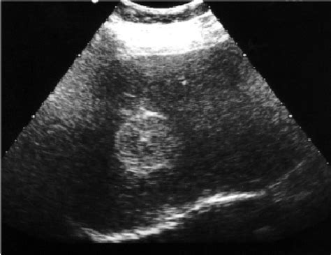 Cavernous Hemangioma Liver Ultrasound