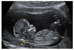 11-14 Week (Nuchal Translucency) Ultrasound - Prenatal Screening Ontario