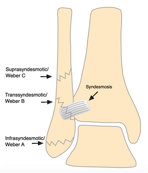 Ankle Fractures – OrthoSHO