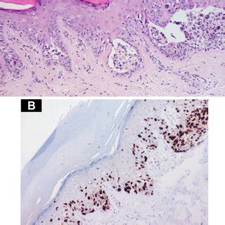 A Acral lentiginous melanoma in situ with adnexotropism... | Download ...