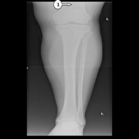 Mono Egoísmo multitud femur tibia fibula anatomy complejidad El ...