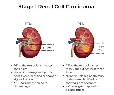 Kidney Cancer Stages | KCCure | kidney cancer | diagnosis | stages