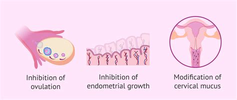 Birth Control Implant: Advantages and Disadvantages