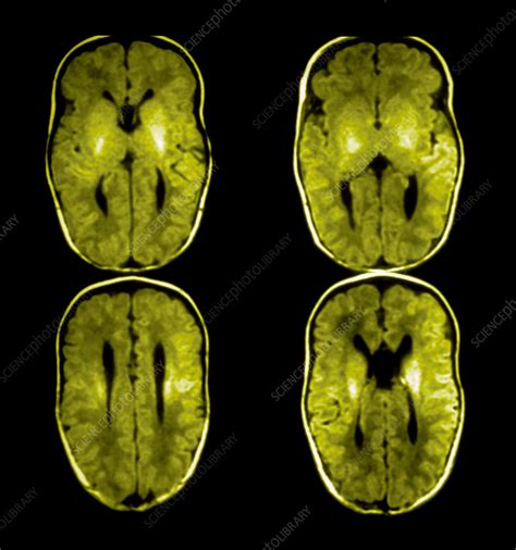 Agenesis of the Corpus Callosum, MRI - Stock Image - C007/5807 ...